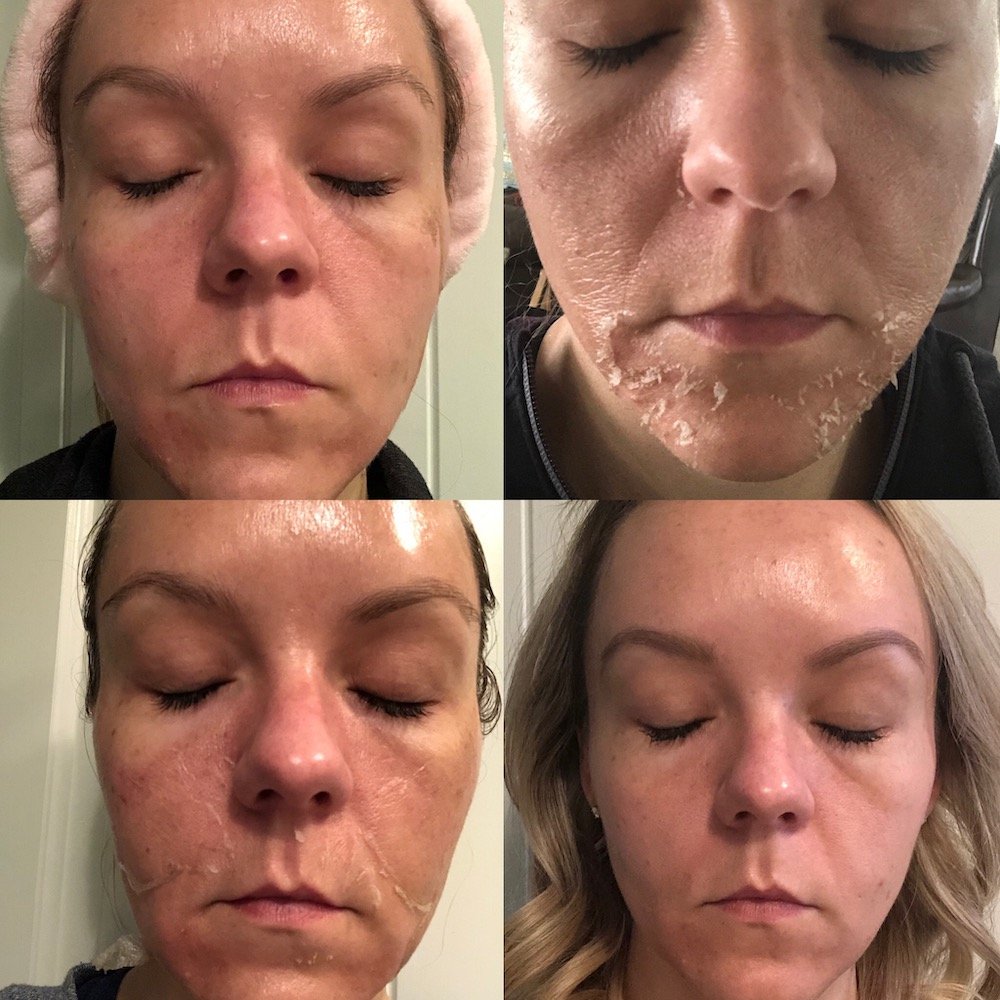 TCA Face Peel