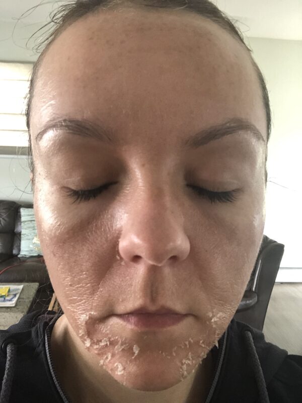 What is a TCA peel? 7 Amazing Days Of Powerful Photos