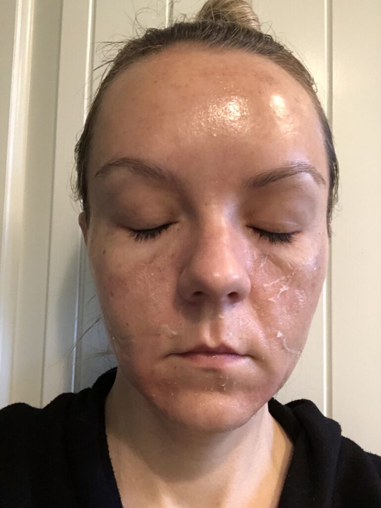 What is a TCA peel? 7 Amazing Days Of Powerful Photos