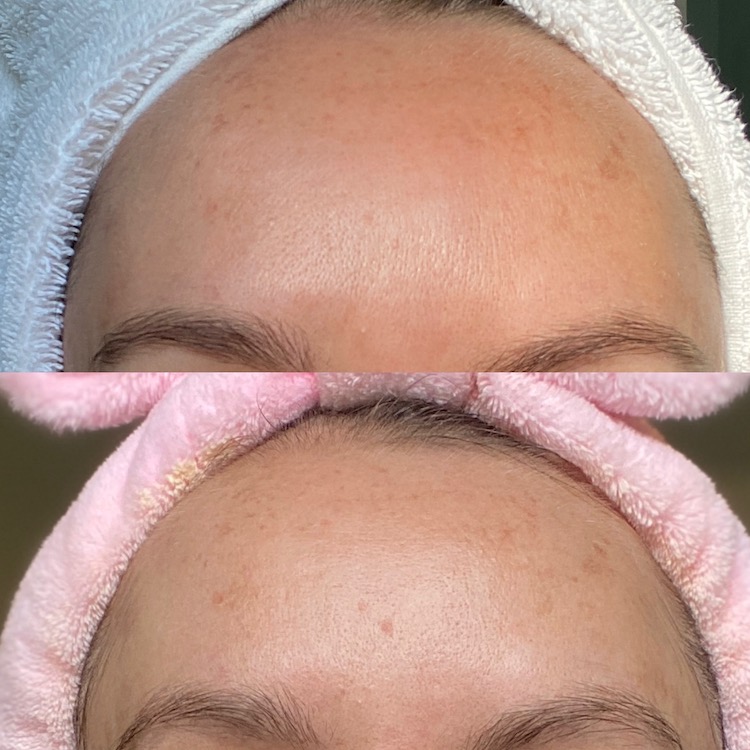 Microneedling Review