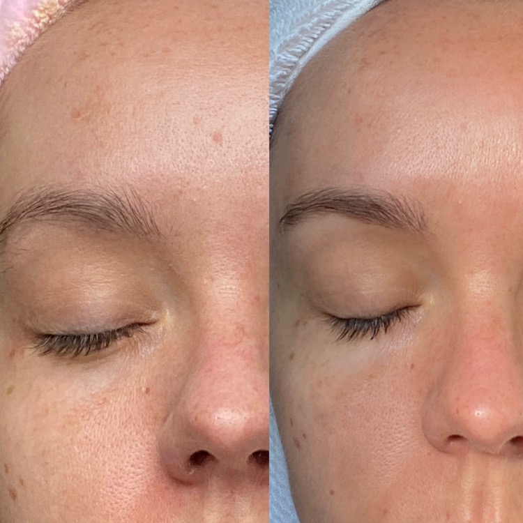 Microneedling Review