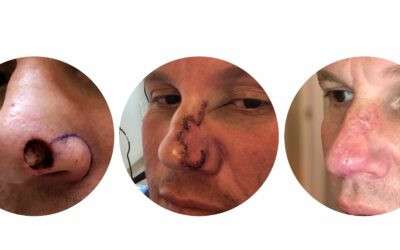 3 Months Of DMK Skincare Saved His Face After Basal Cell Carcinoma