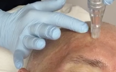 Barry’s Incredible PRP MicroNeedling Treatment Experience