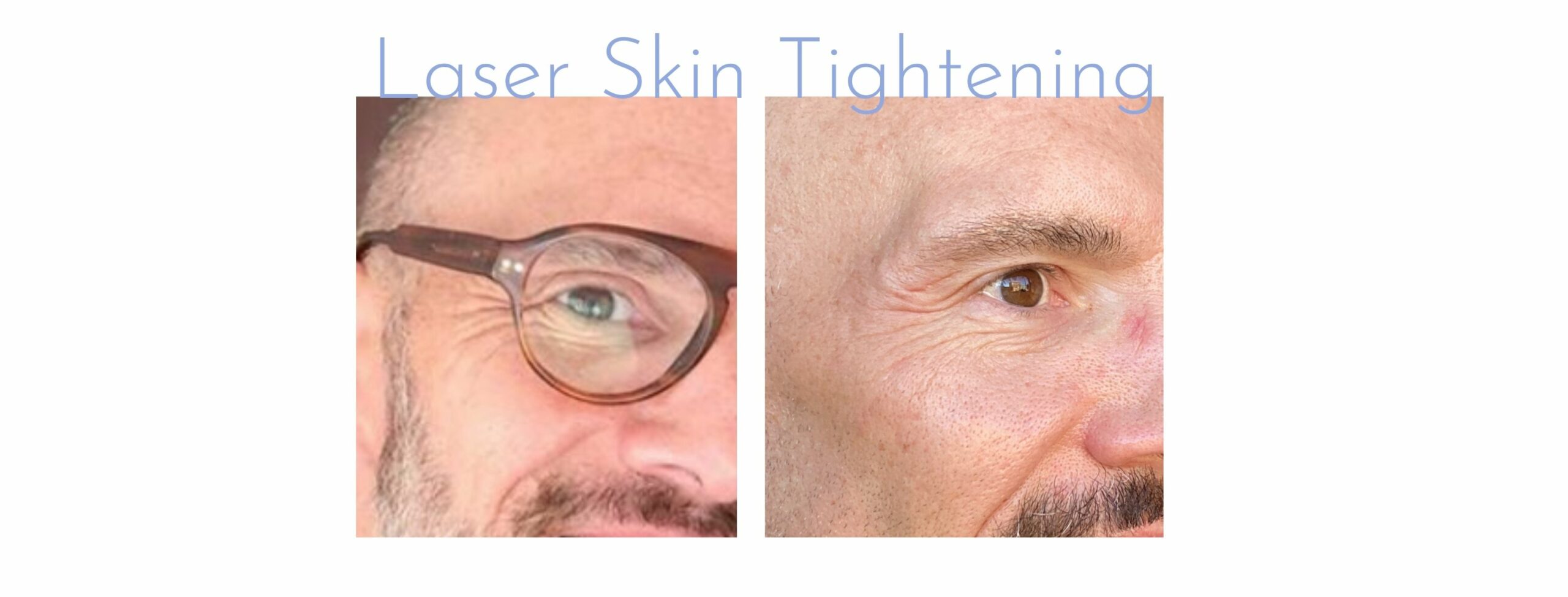 laser skin tightening