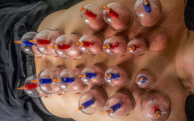 Cupping Therapy – 2 Reasons A Chiropractor Performs Cupping