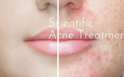 The 3 Pronged Scientific Skin Treatment for Acne