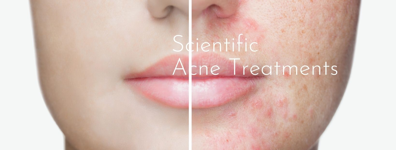 skin treatment for acne