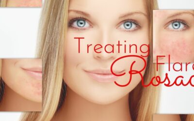 Treatments For Rosacea Flare Ups