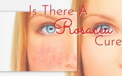 Can a Rosacea Cure Be Found in Synbiotic Skin Care and Ingestables?