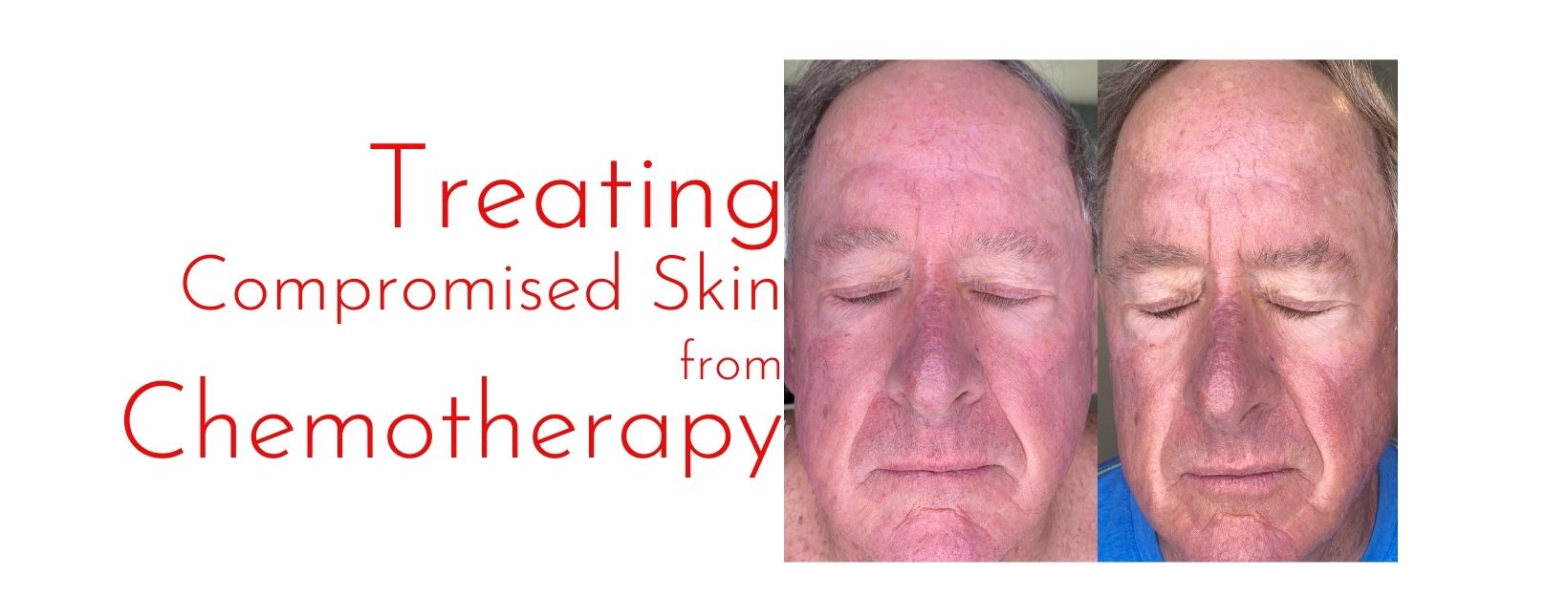 Treatments To Heal Compromised Skin After Topical Chemotherapy