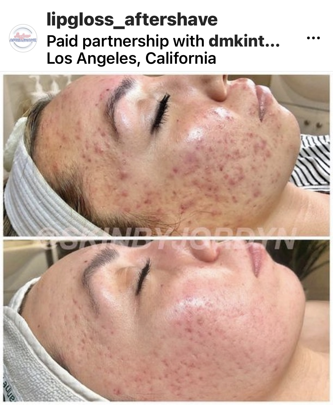 treating acne