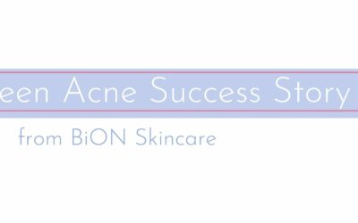 BiON’s Teen Acne Success Story