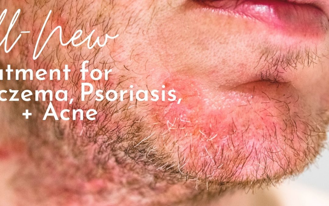 eczema and psoriasis