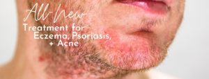 eczema and psoriasis