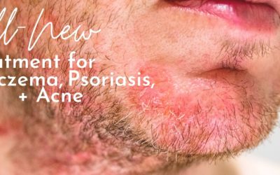 All-New Treatment for Psoriasis, Acne + Eczema
