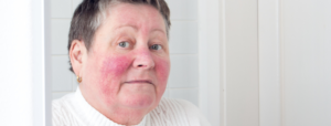 types of rosacea