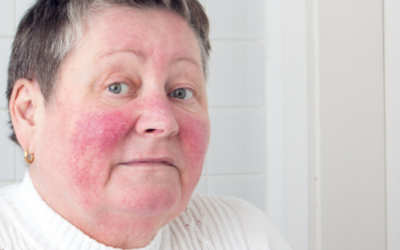 The 4 Types of Rosacea + Their Symptoms?