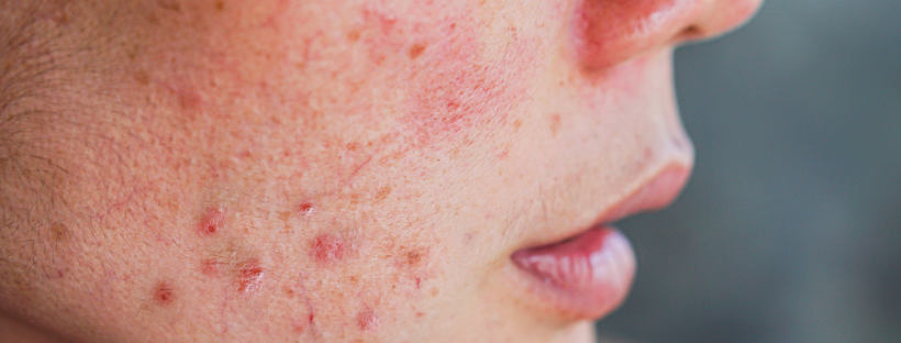 Which Comes First, Inflammation or Compromised Skin?