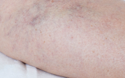 Thrombophlebitis And The Client with Cancer