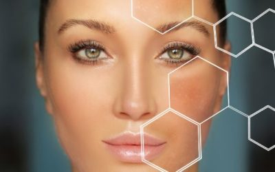 The Formation of Hyperpigmentation