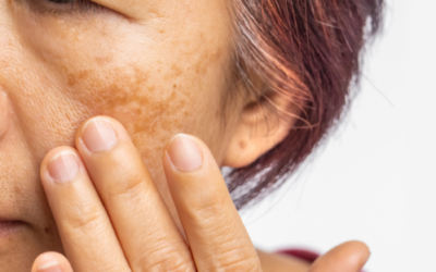 Adios Sun Damage! The Bright Wrinkle-Filler Facial