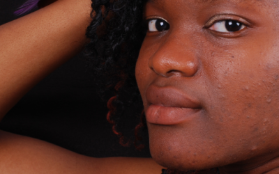 5 Tips to Treating Acne in People of Color