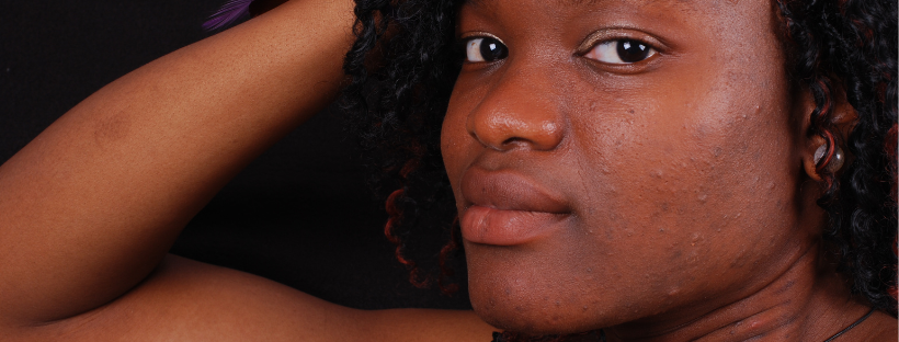 acne in people of color