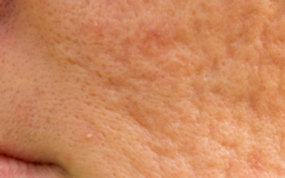 Become An Acne Scar Revision Treatment Expert