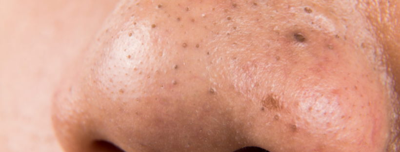 Managing and Treating Blackheads