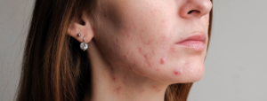 sensitive skin acne