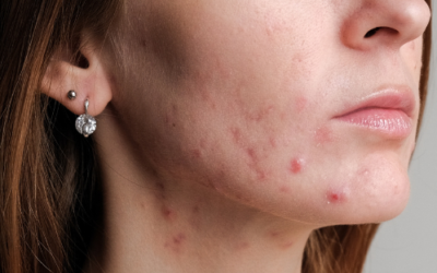 Treating Sensitive Skin Acne