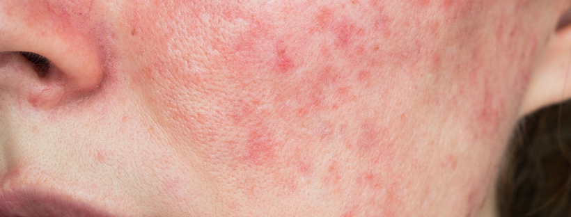 Supplements For Rosacea