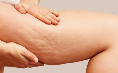 Understanding Cellulite and Body Sculpting