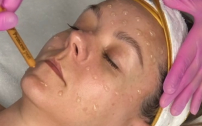 The Peel That Infuses Gold Into The Skin for Wound Healing 