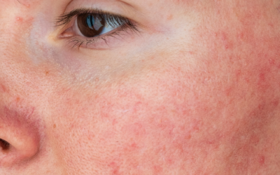 How This Esthetician Can Microchannel Rosacea Clients