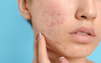 How Do You Treat These 4 Acne Clients?