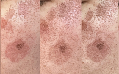 Using CO2 Laser + Other Modalities to Treat Skin Pigmentation