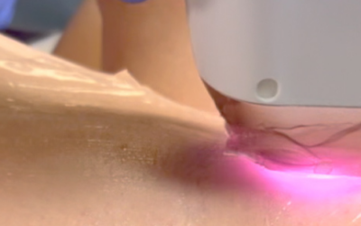 Learn Laser Hair Removal and IPL 