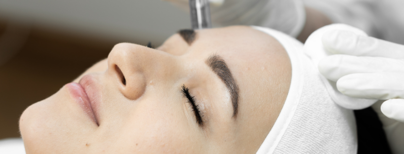 microneedling