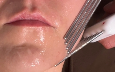 What Elite Aesthetic Pros Can Use to Fast-Track Skin Transformation with Dynamic Microcurrent Facial Technology