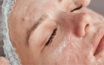 Acne: More Than Just a Phase