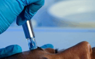 Post-Care Power: Exosomes + NanoInfusion