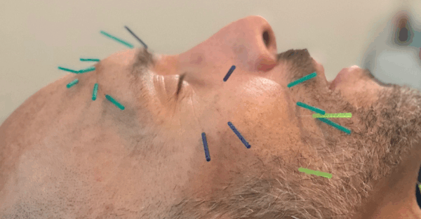 facial acupuncture