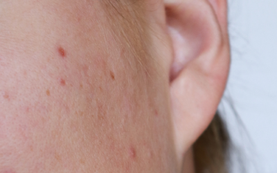 Scar Management & Revision: Healing Skin, Restoring Function, Rebuilding Confidence
