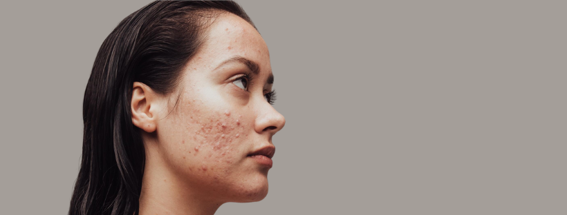 Keys to Clearing: The Proven Actives Behind the #1 Professional Acne Brand