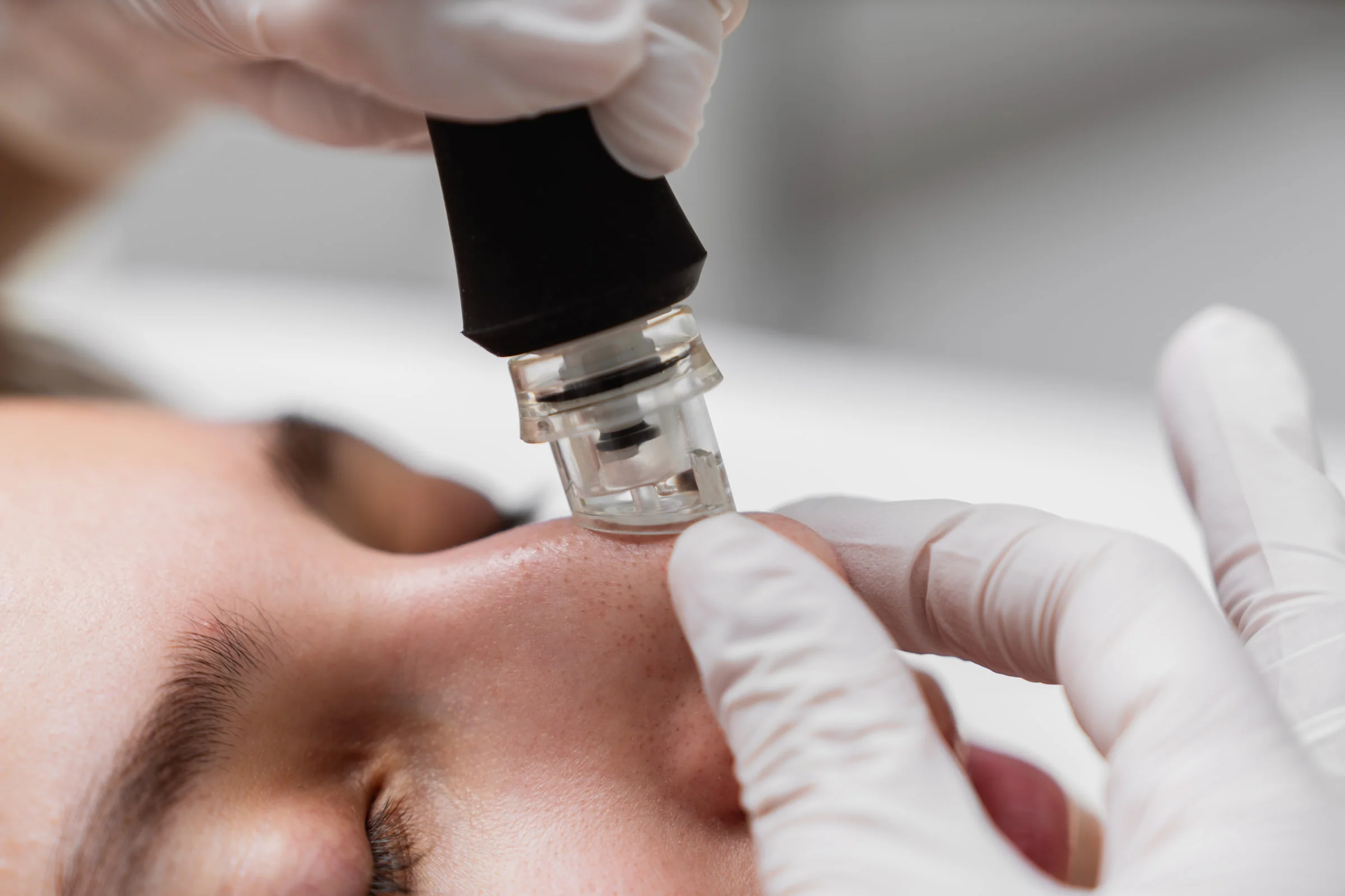 microdermabrasion