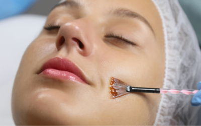 Discover the Double Peel: A New Approach to Acne & Pigmentation