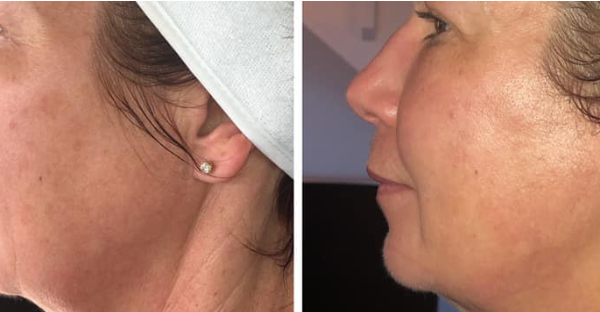 Dermal Lift Treatment