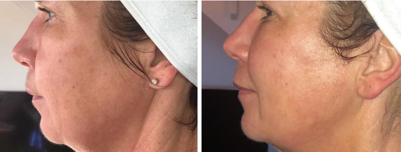 Dermal Lift Treatment