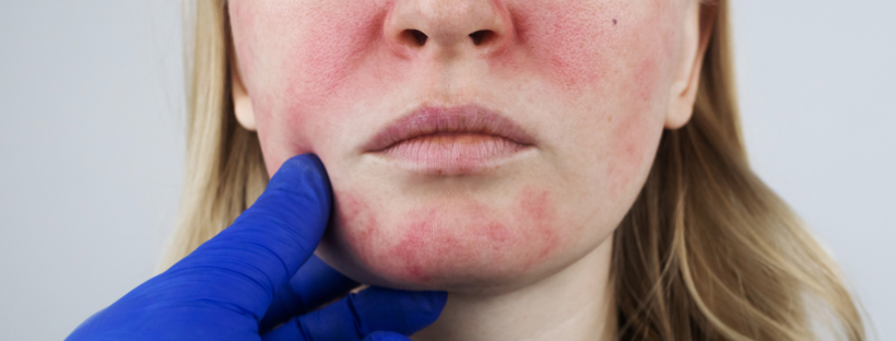 Regenerative Road Map for Rosacea
